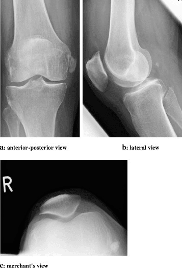 AP knee radiograph showing a round calcific deposit within the proximal medial collateral ligament