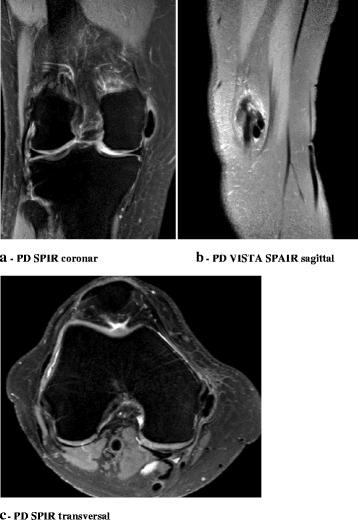 MRI of the knee showing low-signal calcific deposit adjacent to the intact MCL at the femoral attachment