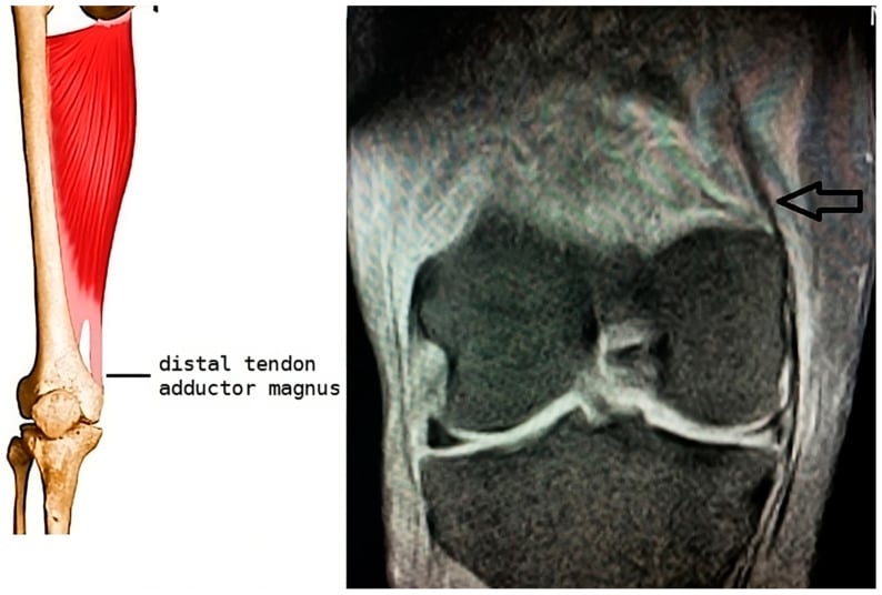 Diagram of the distal adductor magnus tendon insertion on the medial femoral condyle with the corresponding coronal MRI