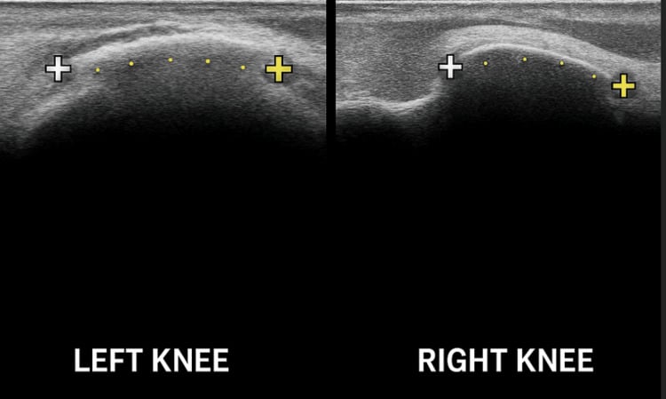 Side-by-side ultrasound images of both knees confirming Pellegrini-Stieda calcification