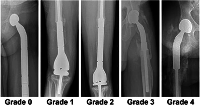 Radiographic series illustrating grades of heterotopic ossification from none through bridging bone