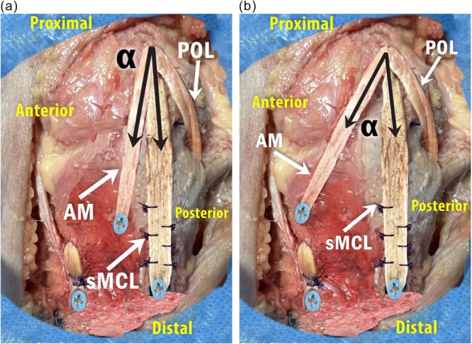 Cadaveric medial view of a right knee labelling the superficial MCL, anteromedial structures and posterior oblique ligament