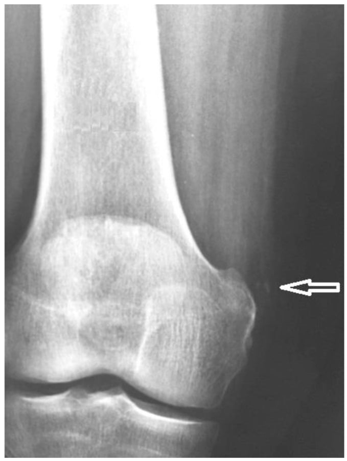 AP knee radiograph one month after ultrasound-guided percutaneous lavage showing only small residual calcific fragments