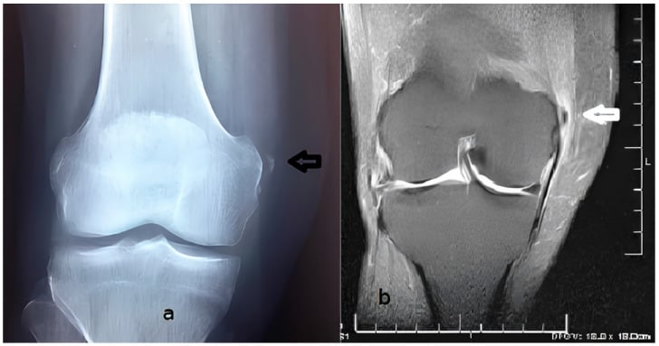 AP radiograph showing calcification adjacent to the medial femoral condyle beside a coronal proton density fat-saturated MRI showing the same hypointense focus