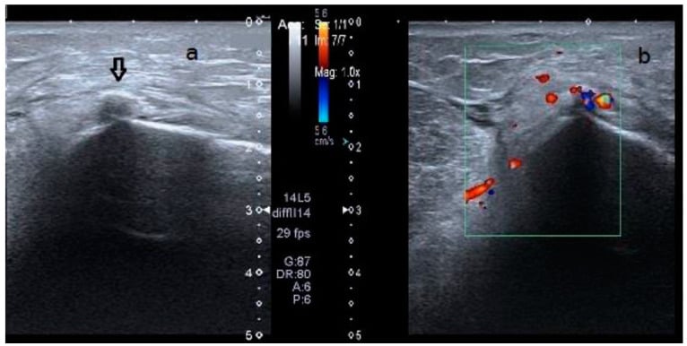 Long-axis ultrasound showing an echogenic focus with posterior acoustic shadowing over the medial femoral condyle and colour Doppler showing hypervascularity