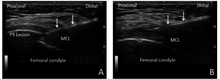 Ultrasound images showing a needle directed at the Pellegrini-Stieda lesion and at the thickened degenerative medial collateral ligament