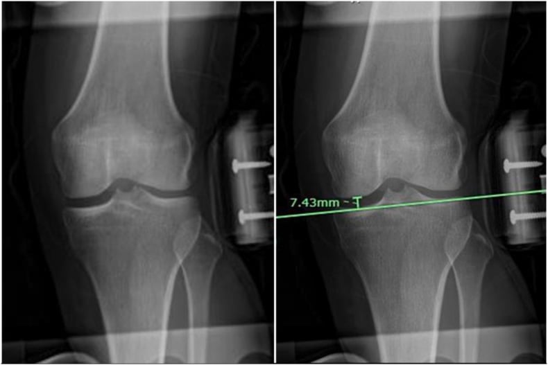 Valgus stress radiograph of the knee with the medial joint space width measured perpendicular to the tibial subchondral line