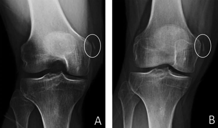 Weight-bearing PA knee radiographs with the knee in 45 degrees of flexion showing a Pellegrini-Stieda lesion before and after treatment
