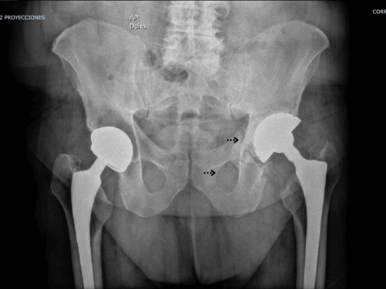 AP pelvis showing pelvic discontinuity with medial displacement of the inferior hemipelvis and asymmetric obturator rings.