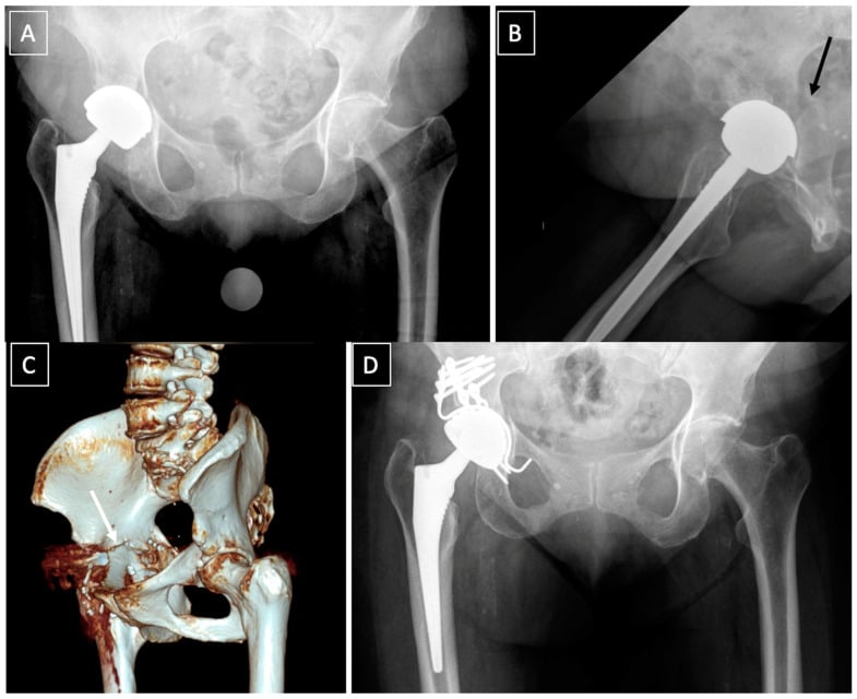 Serial radiographs and three-dimensional CT showing failed non-operative treatment of an acetabular fracture, transverse nonunion, and subsequent posterior-column plating with acetabular reconstruction.