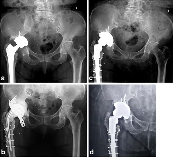 Serial radiographs of chronic pelvic discontinuity associated with periprosthetic joint infection through spacer placement, second-stage reconstruction and one-year follow-up.