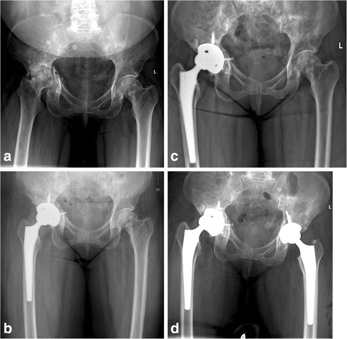 Serial pelvic radiographs showing pathological acetabular fracture, immediate reconstruction, later cup migration and subsequent observation without revision in an asymptomatic patient.