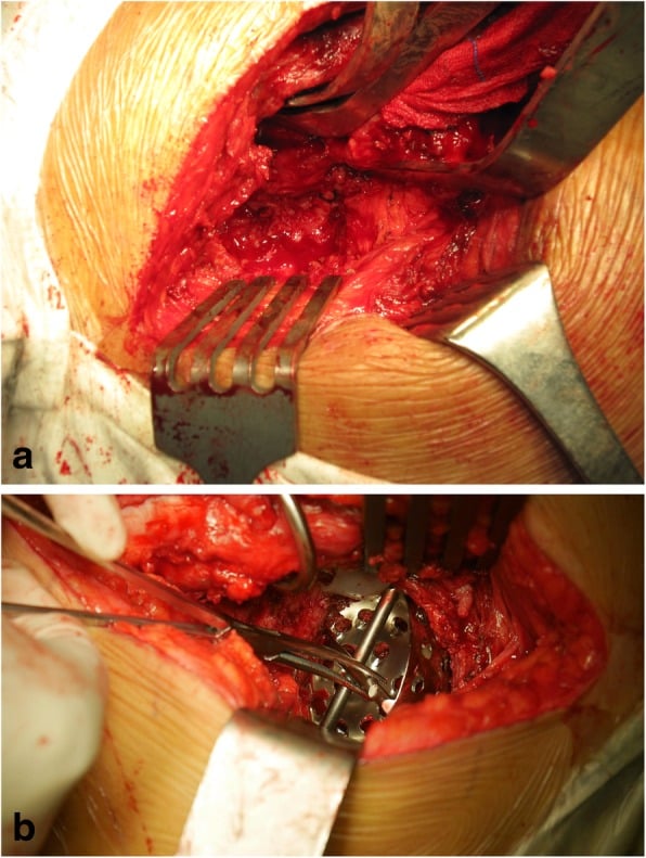 Intraoperative photographs confirming pelvic discontinuity by engaging the acetabulum with a reamer and observing the segment move as one unit.