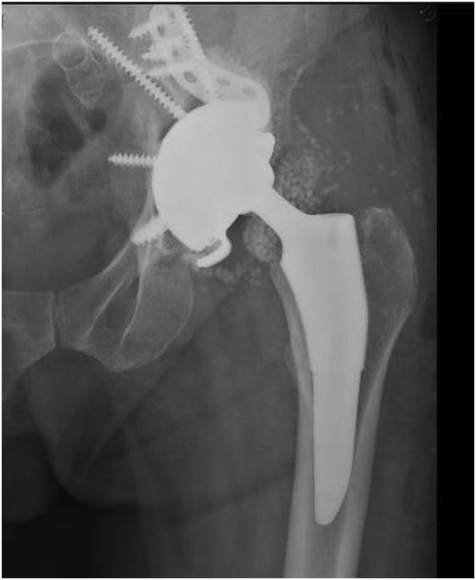 Postoperative hip radiograph showing a cup-cage construct with a modular dual-mobility liner.