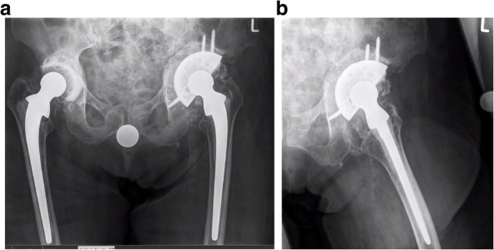 Anteroposterior and lateral radiographs after acetabular distraction with allograft, a large porous revision shell, locking screws and reverse augmentation.