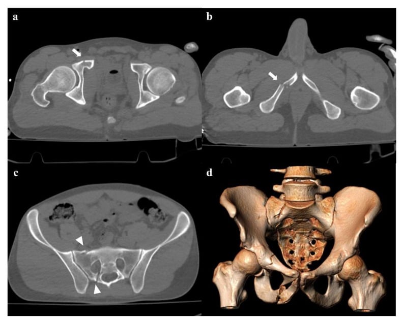 Lateral compression type 1 pelvic ring injury