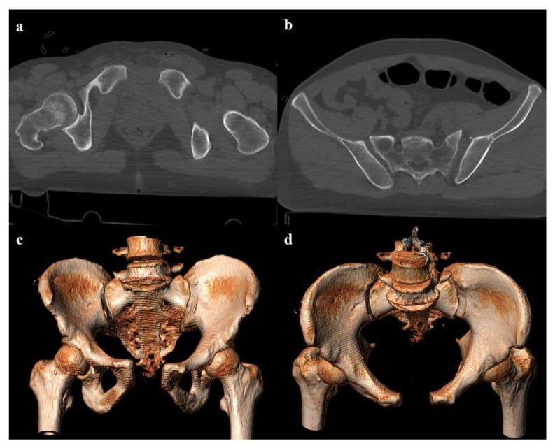 APC type 3 open book pelvic ring injury on CT and 3D reconstruction