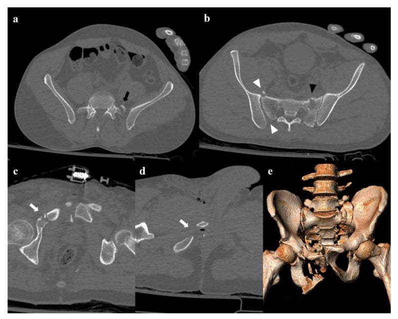 Vertical shear pelvic ring injury on CT and 3D reconstruction