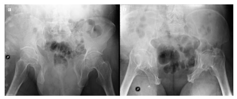 Pelvic inlet and outlet radiographs demonstrating pelvic ring assessment views