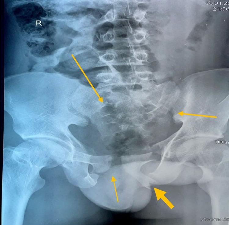 AP pelvis radiograph of a complex pelvic ring injury with multiple fracture sites.