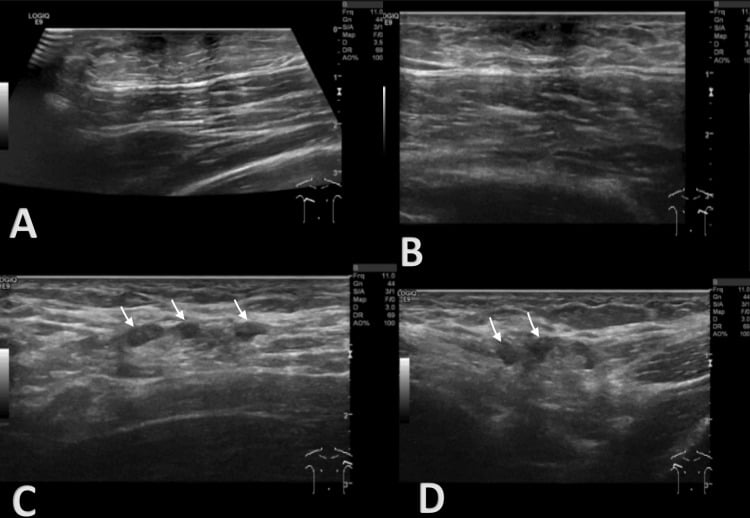 Bilateral breast and axillary ultrasound showing dendritic gynaecomastia in anabolic steroid use