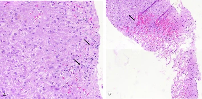 Liver biopsy showing lobular inflammation and focal congestion after nandrolone and supplement exposure