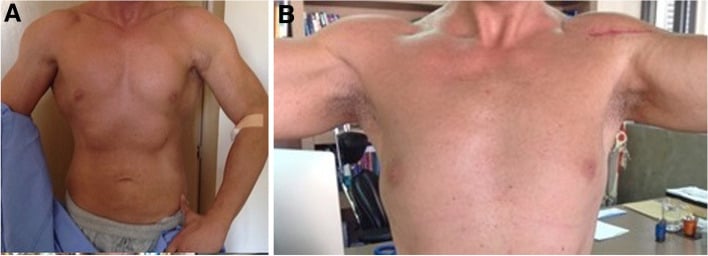 Clinical photographs of a complete pectoralis major rupture in a bodybuilder before and after surgical repair