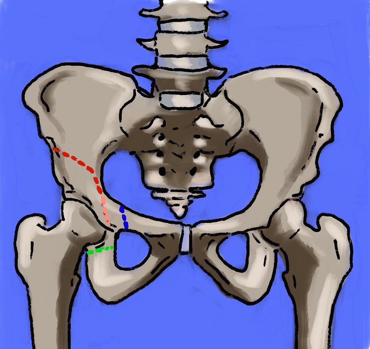 Schematic AP pelvis showing the periacetabular osteotomy cuts marked as coloured dashed lines around one acetabulum.