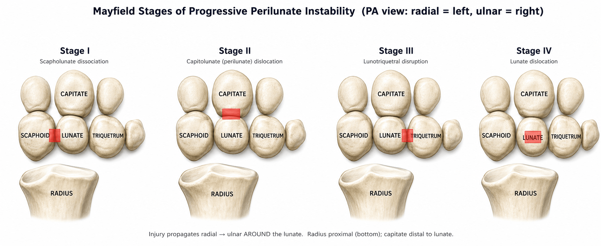 Mayfield stages of perilunate instability