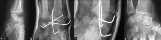 Chronic perilunate dislocation treated with K-wire stabilisation sequence