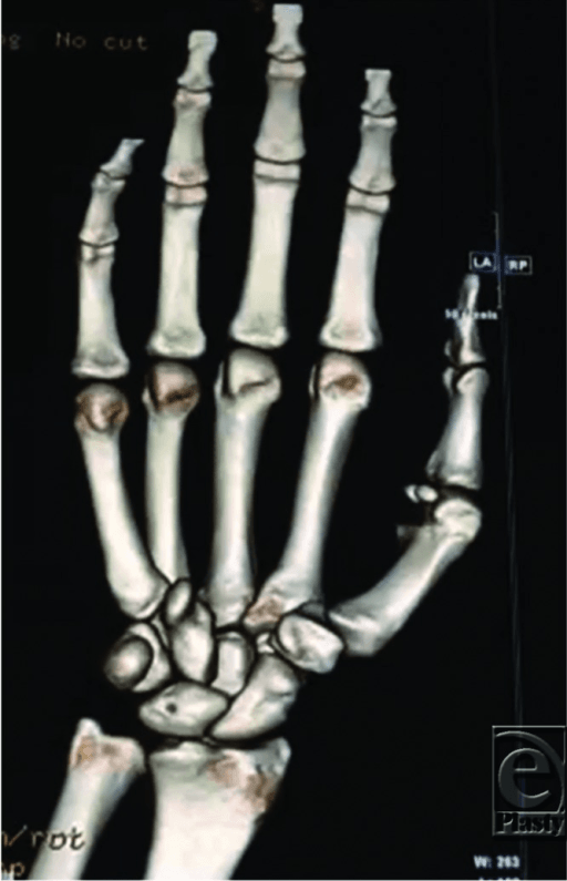 Perilunate Injuries and Carpal Dislocations - three-dimensional CT reconstruction showing carpal bones and articular surfaces.
