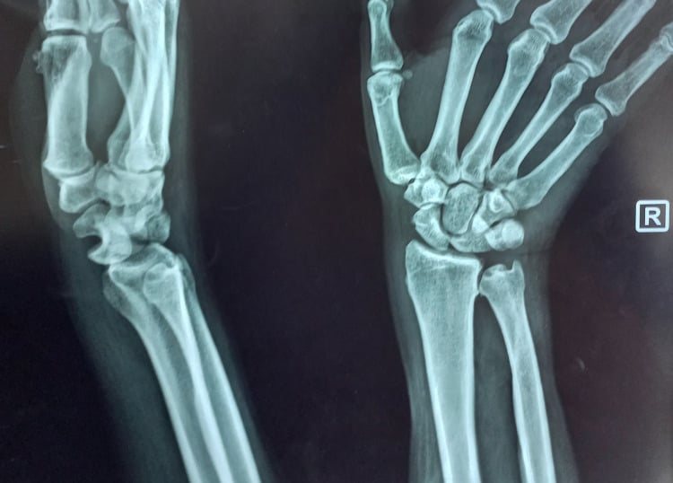 PA and lateral radiographs of perilunate dislocation demonstrating spilled teacup sign
