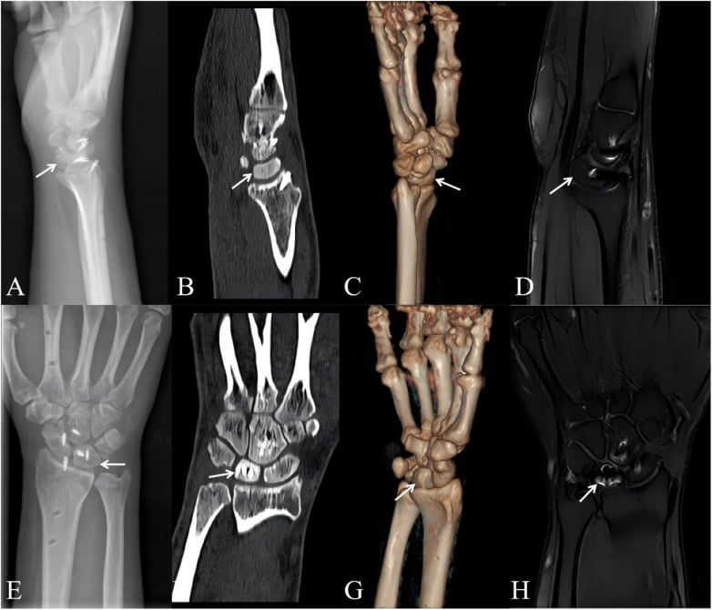 Preoperative imaging, 3D CT, and postoperative radiographs of perilunate dislocation repair