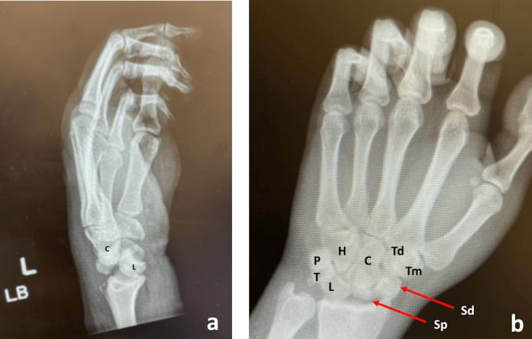 Radiographs of transscaphoid perilunate dislocation with scaphoid fracture