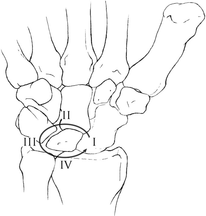 Line diagram illustrating Mayfield stages of perilunate instability