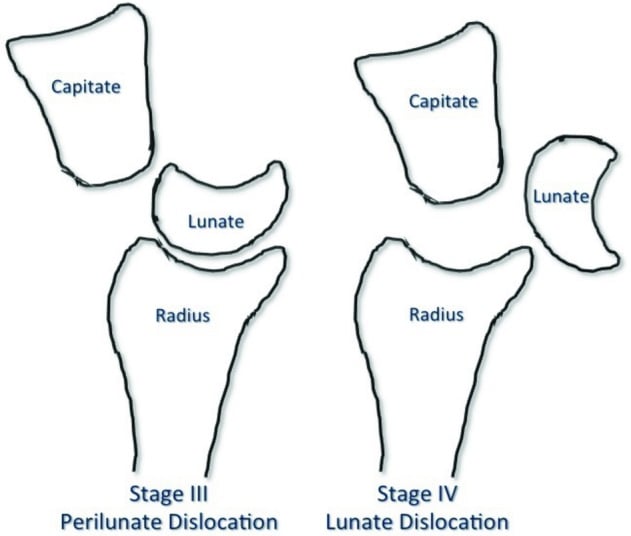 Line diagram comparing perilunate dislocation versus lunate dislocation