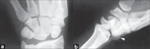 PA and lateral wrist radiographs with perilunate dislocation