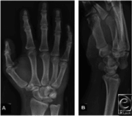 PA and lateral wrist radiographs demonstrating perilunate dislocation