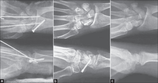 Radiographic sequence after operative fixation for perilunate injury