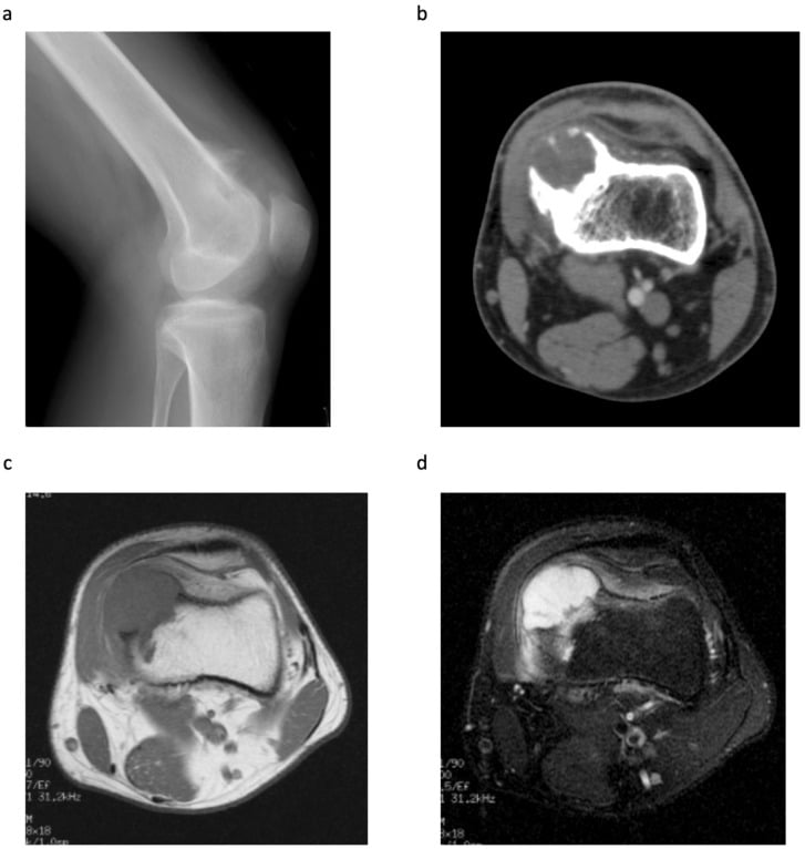 Multimodal imaging of a distal femoral periosteal chondrosarcoma - radiograph, CT and MRI