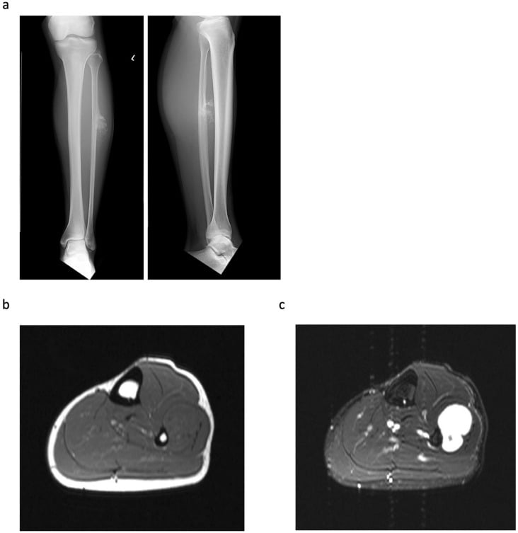 AP radiograph and coronal T2 MRI of proximal humerus periosteal chondrosarcoma
