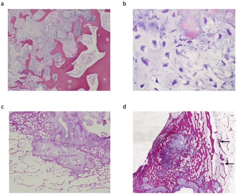 Histopathological H&E section of Grade II periosteal chondrosarcoma