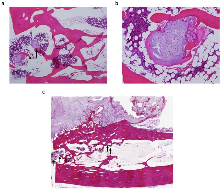 Histopathological H&E section of Grade I periosteal chondrosarcoma