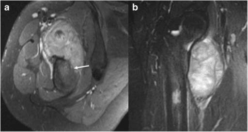 Axial and coronal T2 MRI of proximal femur showing bright soft-tissue mass around bone with cortical breach.