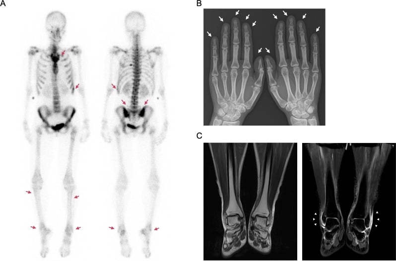 Chest CT showing a pulmonary lesion beside a whole-body bone scan with symmetrical distal long-bone uptake.