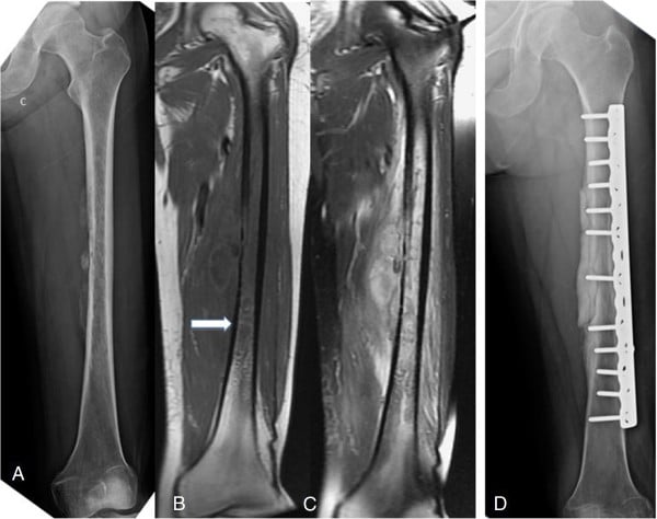 Femur radiograph showing a thin monolayer of periosteal new bone with corresponding T1- and T2-weighted MRI.
