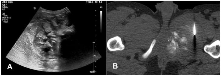 Anteroposterior and lateral radiographs of a fibular diaphysis with a mineralised extraosseous mass and spiculated sunburst periosteal reaction.