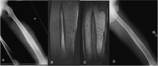 Femoral radiograph showing lesion with sclerotic border and septated periosteal reaction, with MRI images.