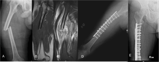 Radiograph of femur with pathological fracture, thinned lateral cortex and layered periosteal reaction, alongside MRI images.
