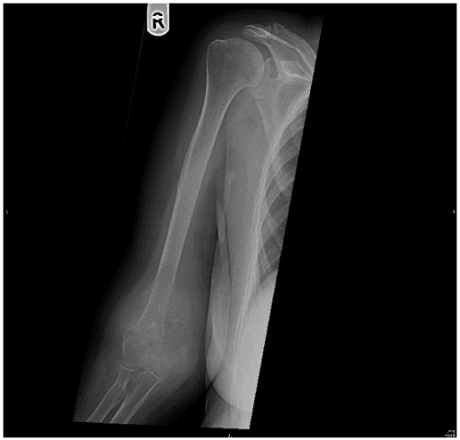 Radiograph of right arm with destructive distal humeral lesion, radiating sunburst periosteal reaction and fracture.